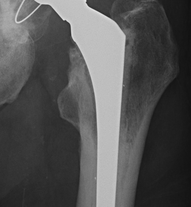 Cemented Femur Probably Loose